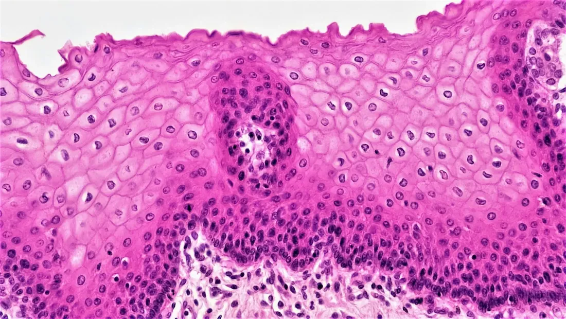 Biopsy tissue under the microscope (illustrative image)